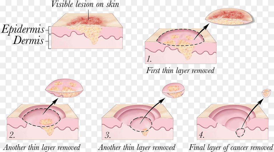 2010 Terese Winslow Skin Cancer Treatment Png Image