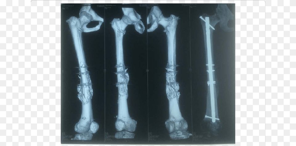 3d Ct Scan And X Ray Of Femur With Accelerated Union 3d Ct Femur, X-ray, Adult, Bride, Female Free Transparent Png