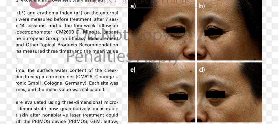 A 50 Year Old Woman Before The Treatment Cd And Close Up, Head, Person, Face, Adult Free Png Download