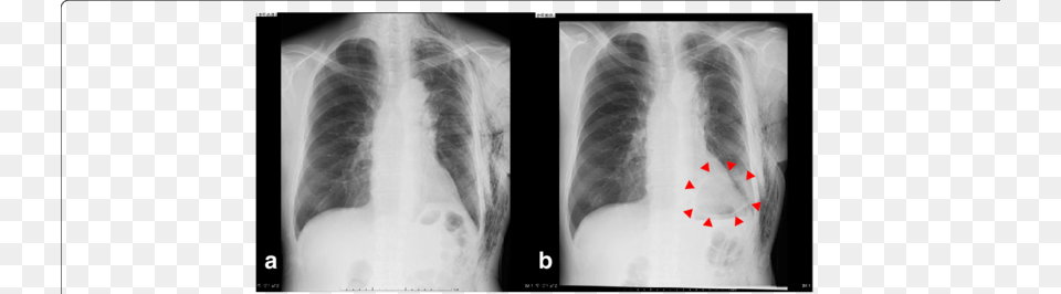 A Chest X Ray On Pod7 Reveals No Dead Space In The Lung, Ct Scan, X-ray, Adult, Bride Free Png Download