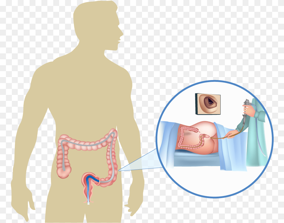 A Colonoscopy Is A Procedure That Examines The Colon Colorectal Cancer, Adult, Female, Person, Woman Free Transparent Png