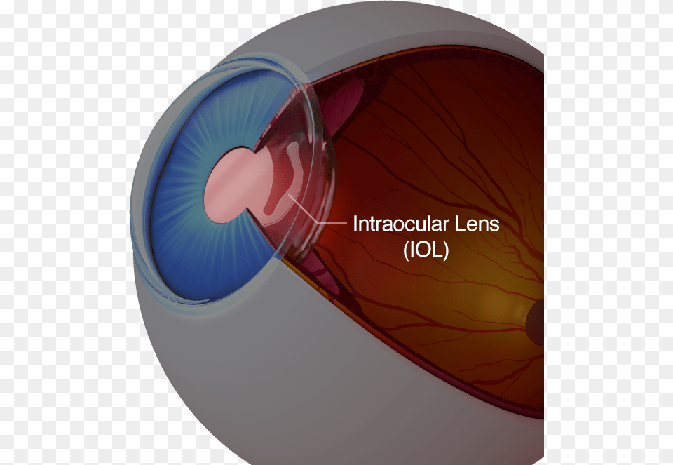 A Diagram Of An Eye With An Intraocular Lens Intraocular Lens, Computer Hardware, Electronics, Hardware, Mouse Png Image