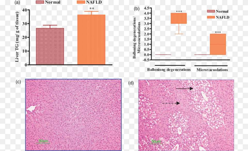 A Elevation In Liver Triglyceride Tg Levels By Dietary Screenshot, Paper Free Png