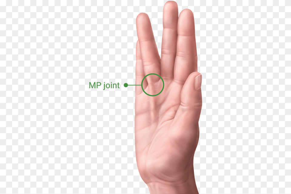 A Hand With Dupuytrens Contracture Showing The Pip Facts On Hand Dupuytren39s Contracture, Body Part, Finger, Person, Wrist Png Image