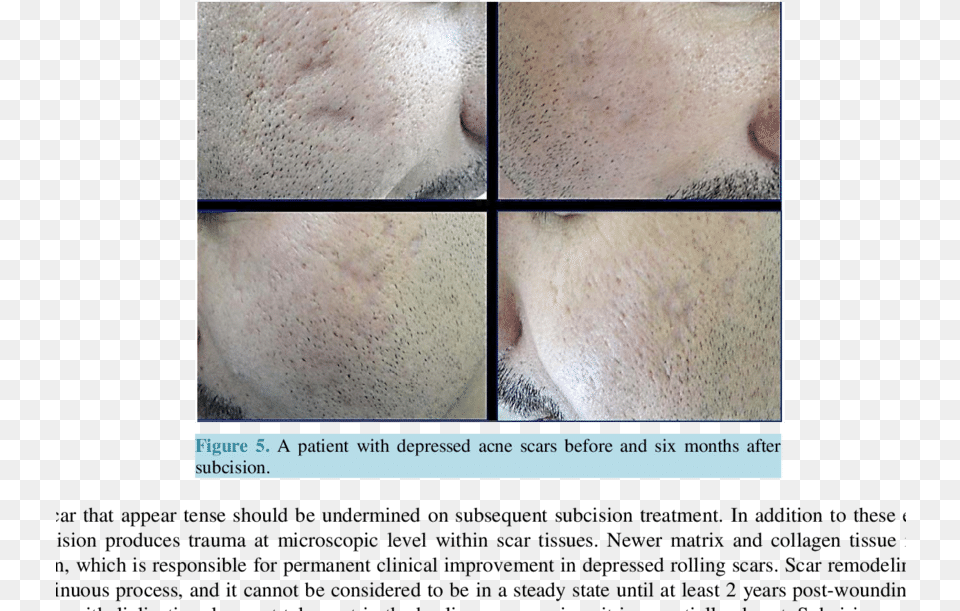 A Patient With Rolling Amp Icepick Acne Scars Before Subcision On Trauma Scars, Romantic, Person, Kissing, Head Png Image