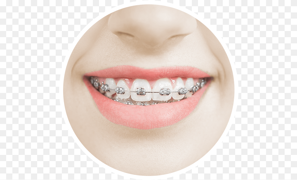A Woman Smiles Happily With Metal Braces On Her Increasingly Smiles With Gold Braces, Body Part, Mouth, Person, Teeth Free Png Download