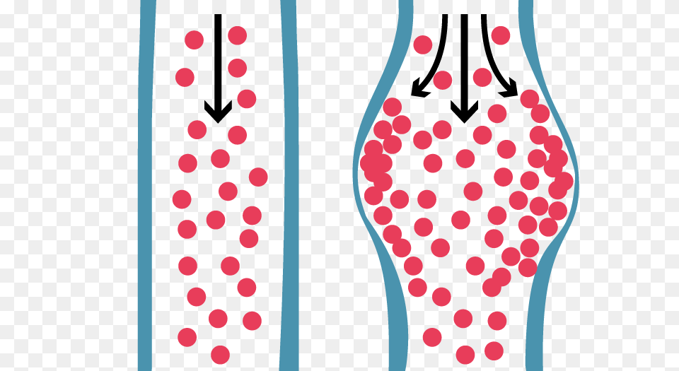 Abdominal Aortic Aneurysm, Pattern Png Image