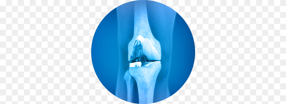 About Partial Knee Joint Replacement Joint K Nee, Ct Scan, Ice, Outdoors, Nature Free Png Download