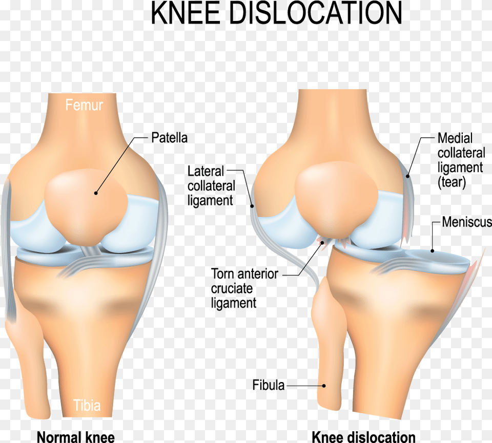 Acl Injury Physiotherapy Treatment Knee Dislocation, Adult, Female, Person, Woman Free Png