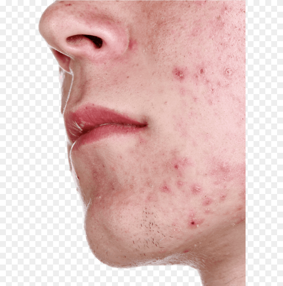 Acne Acne Images Face, Head, Person, Skin Free Png Download