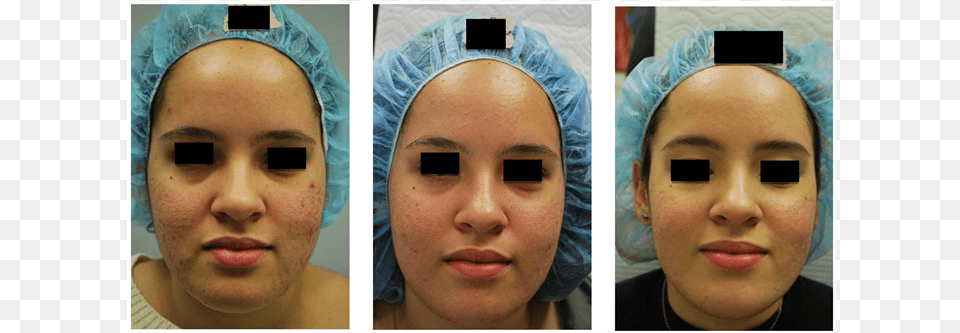 Acne Acne Scarring And Pores Before 1 Month Post Mask, Face, Person, Head, Baby Free Png