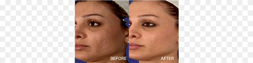 Acne Scars Laser Skin Resurfacing Before, Adult, Face, Female, Head Free Png