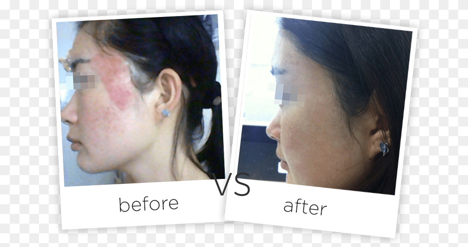 Acne Scars Treatment Adss Laser Number, Accessories, Person, Jewelry, Head Free Transparent Png