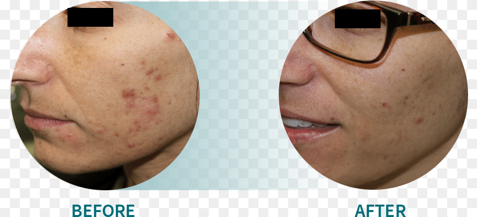 Active Acneacne Scars, Person, Face, Head, Woman Free Png