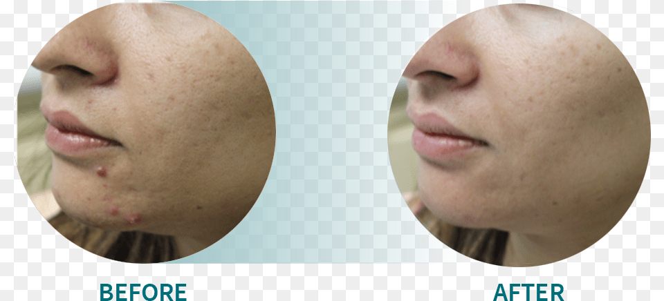 Active Acneacne Scars Gold, Face, Head, Person, Adult Free Png