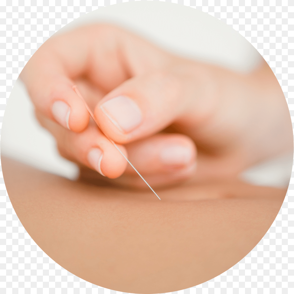 Acupuncture Acupuncture, Body Part, Hand, Nail, Person Free Transparent Png