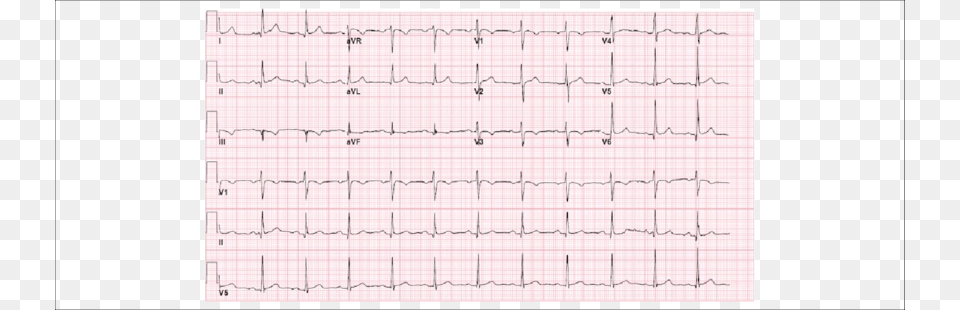 Admission Ekg With Q Waves In The Inferior Leads And Number, Chart, Page, Plot, Text Png Image