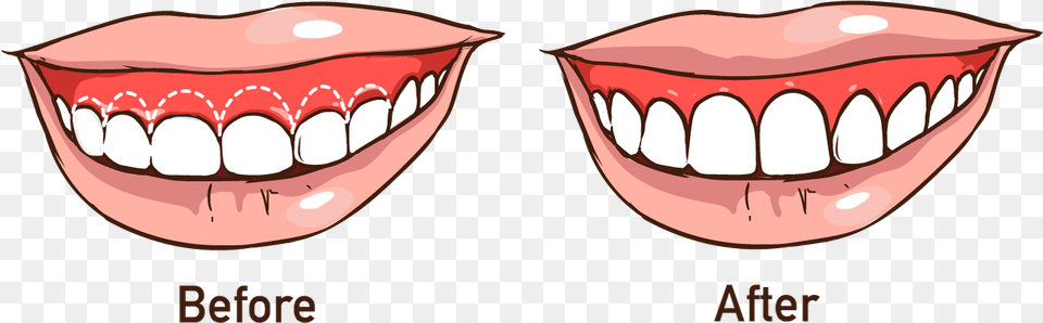 Advanced Dental Care Straight Line Teeth, Body Part, Mouth, Person Png Image