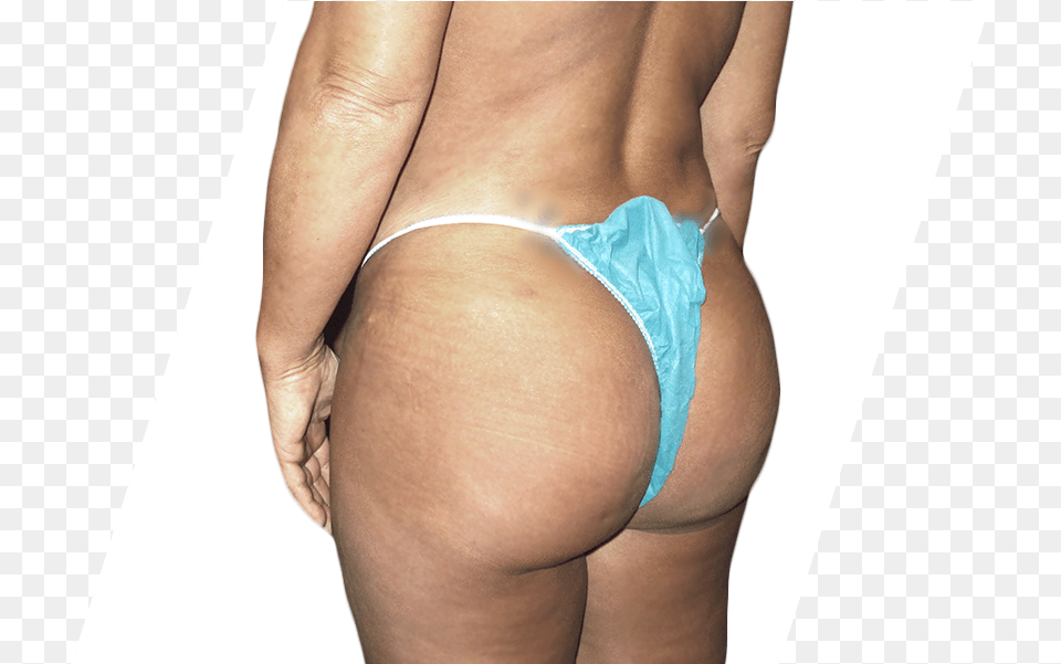 After Brazilian Butt Lift Brazilian Buttocks, Clothing, Lingerie, Panties, Thong Free Png Download