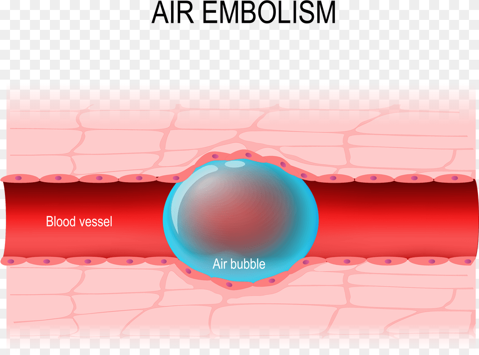 Air Embolism, Sphere, Page, Text Free Png