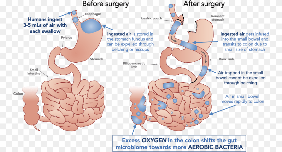 Air Hypothesis Bariatric Surgery And Gut Microbiome, Body Part, Stomach, Adult, Female Free Transparent Png