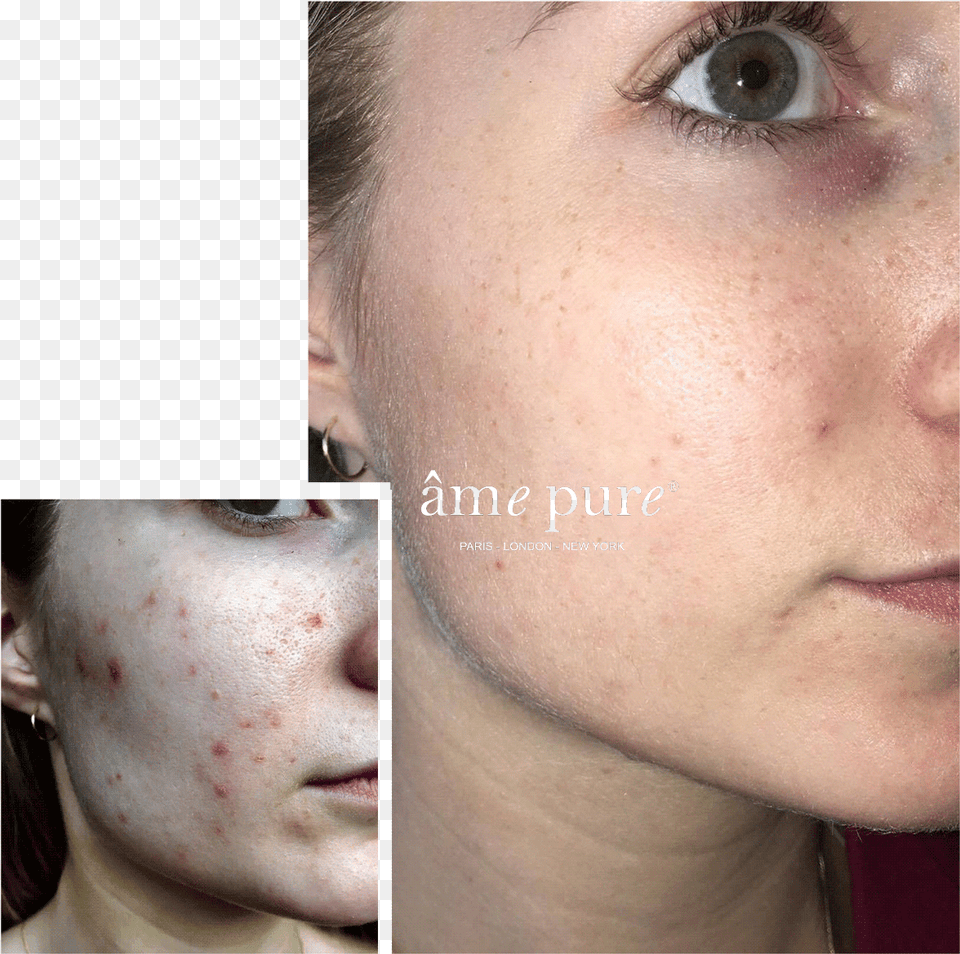 Ame Pure Before And After, Face, Head, Person, Baby Free Png Download