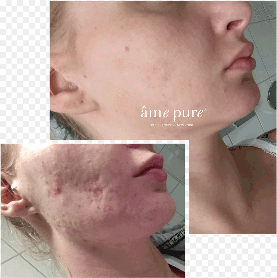 Ame Pure Before And After, Body Part, Face, Head, Neck Free Transparent Png