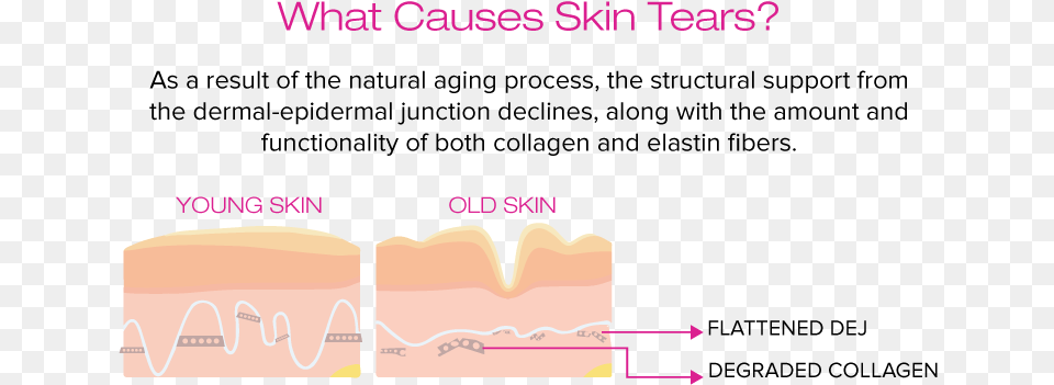 Amige What Causes Skin Tears Dermal Epidermal Junction Aging, Body Part, Mouth, Person, Teeth Png Image