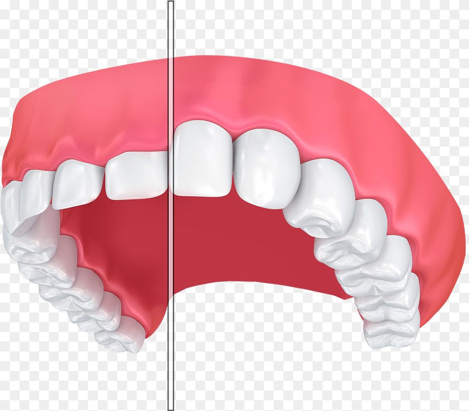 An Illustration Of Before And After Laser Gum Contouring Estetik Dolgu, Body Part, Mouth, Person, Teeth Png