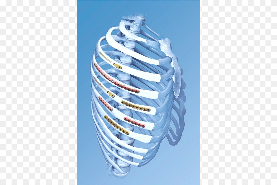 An Image Show Fracture Ribs Treated With Titanium Plates Rib Fracture Plate, Coil, Spiral Free Transparent Png