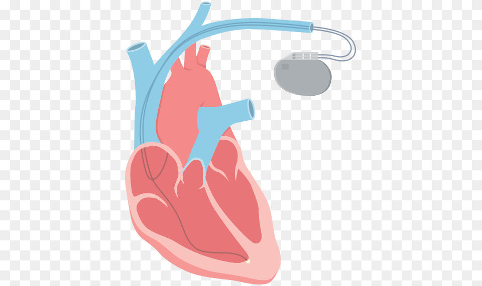 An Irregular Heart Rhythm That Is Too Slow Usually Artificial Cardiac Pacemaker, Architecture, Building, Hospital, Clinic Free Png