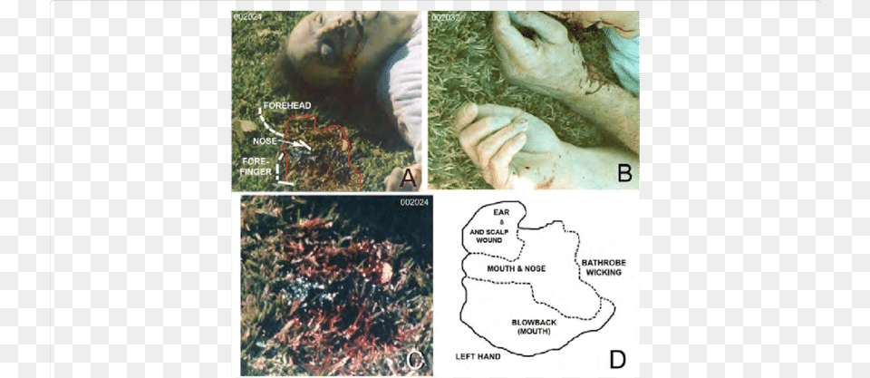Analysis Of The Bloodstain In The Grass Under And In Face, Barefoot, Person, Baby, Injury Free Png Download