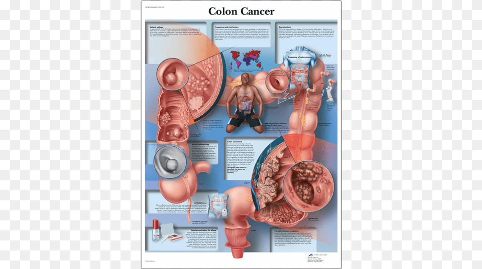Anatomical Chart Colon Cancer Colon Cancer Anatomy, Adult, Male, Man, Person Free Png Download