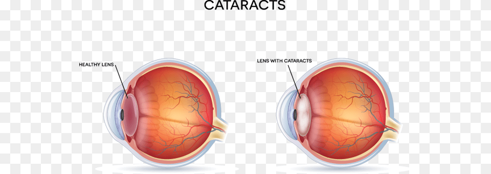 Anatomy Of The Eye With Cataracts Diagram Of Cataract, Ct Scan, Smoke Pipe, Face, Head Free Transparent Png
