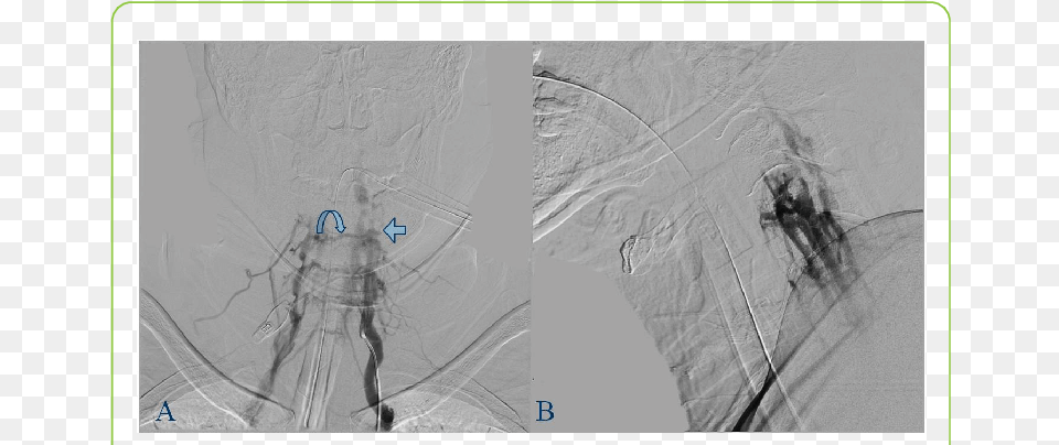 Angiography Ap View B Lateral View Demonstrating Illustration, Art, Collage, Outdoors, Sport Free Png