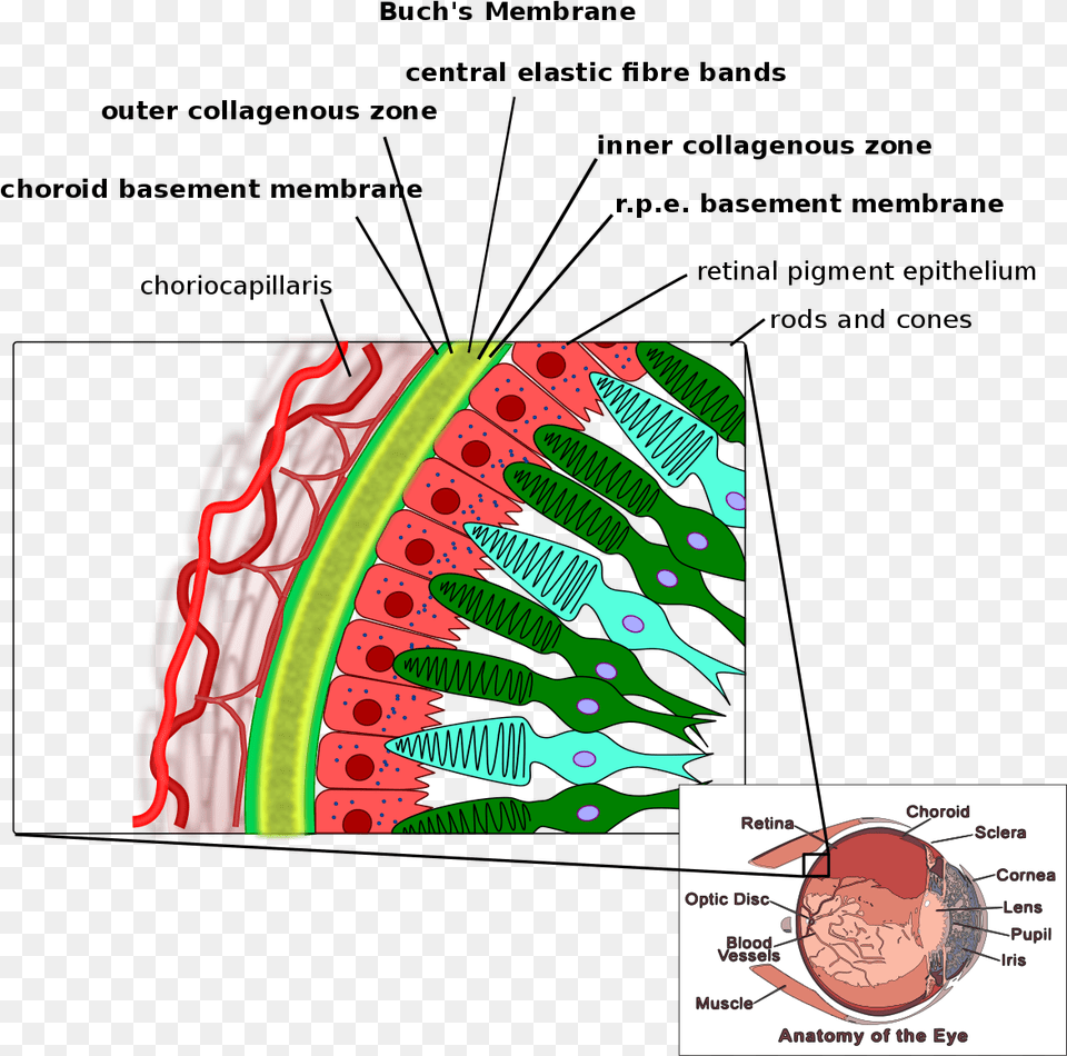 Angioid Streaks Bruch Membrane, Food, Fruit, Plant, Produce Png Image