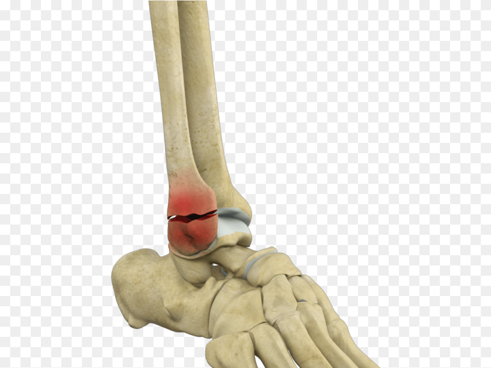 Ankle Fracture Repair Los Angeles Fractured Ankle, Baby, Person Png