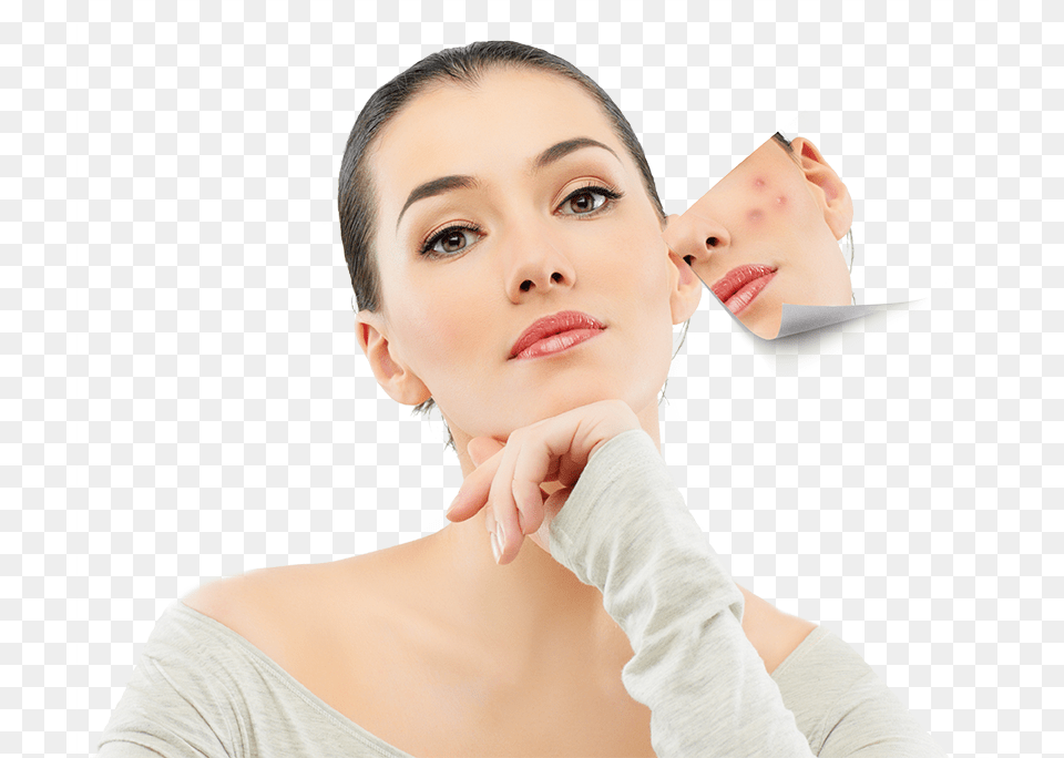 Anti Acne Veluxio Naturals Best Blackhead Remover And Comedone, Adult, Person, Head, Female Png Image