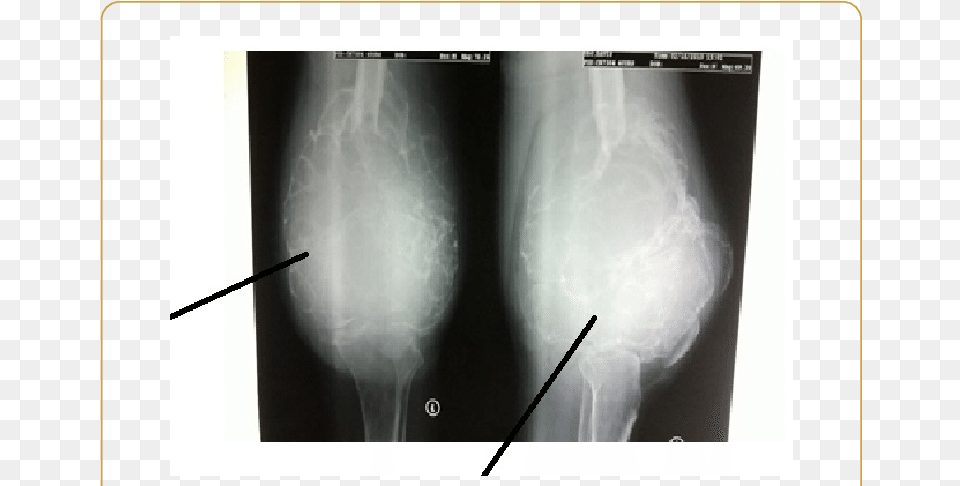 Ap And Lateral Radiographs Of The Left Knee Joint Medical Radiography, X-ray, Person Png