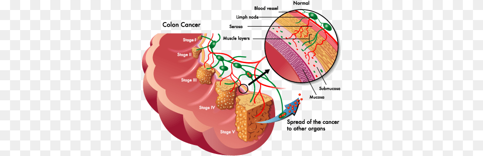 Approximately New Cases Of Colorectal Cancer Colon Cancer Stages Png Image