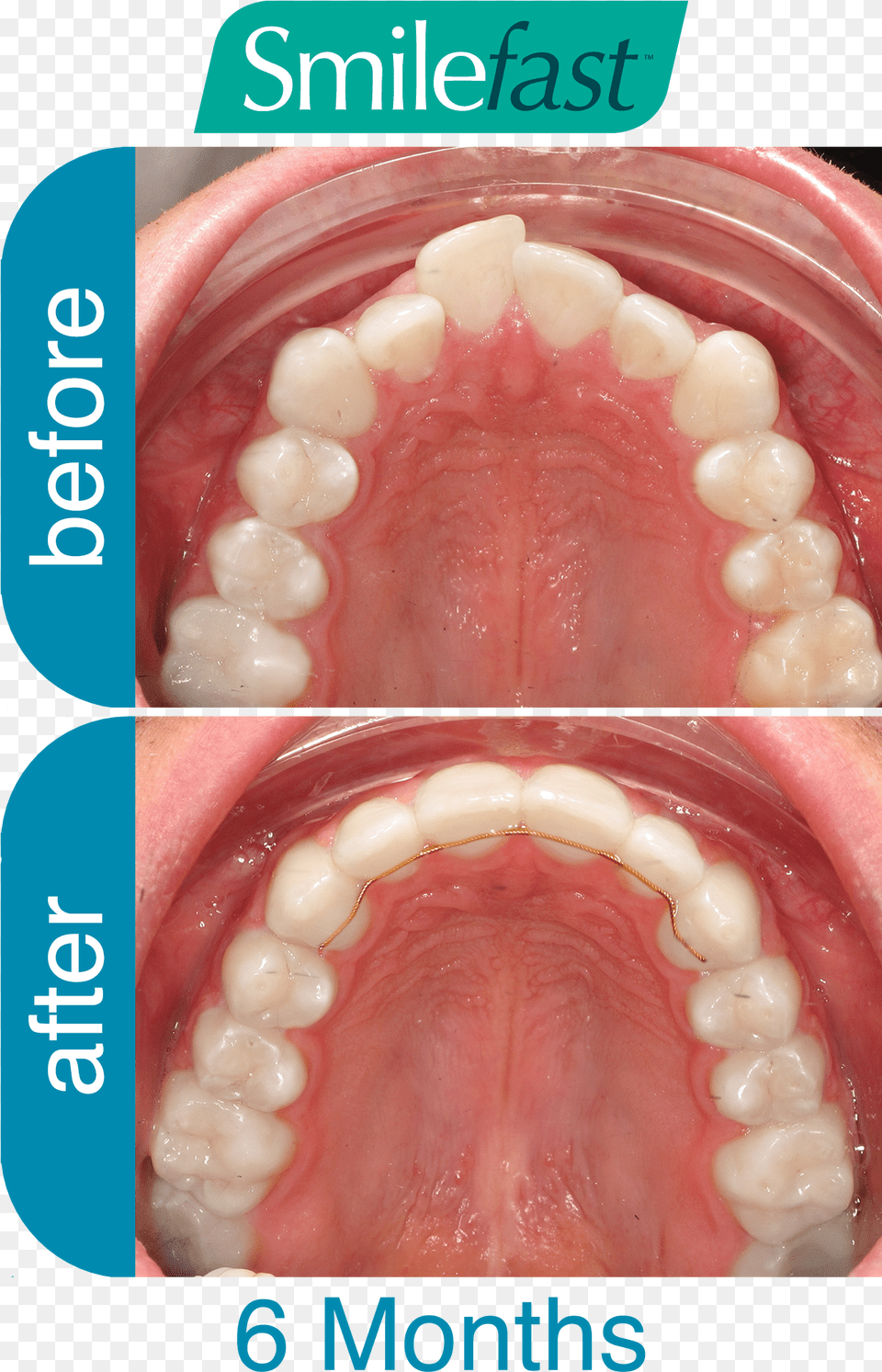 Aqd Smilefast After 6 Months Fast Braces Buck Teeth Before And After, Body Part, Face, Head, Mouth Free Transparent Png