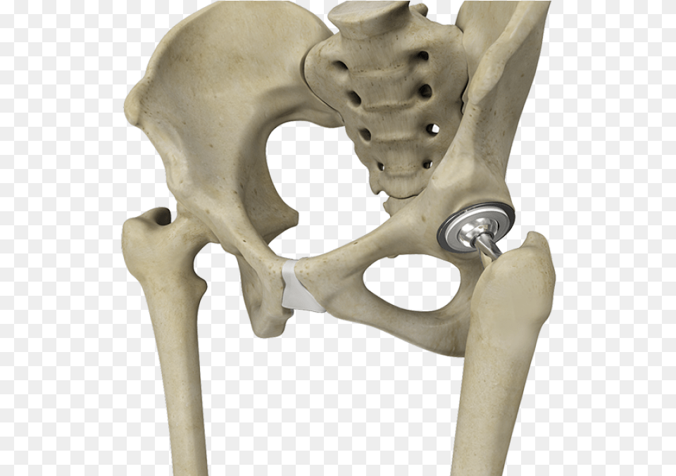 Artificial Hip Joint Total Hip Replacement, Animal, Dinosaur, Reptile Free Png Download