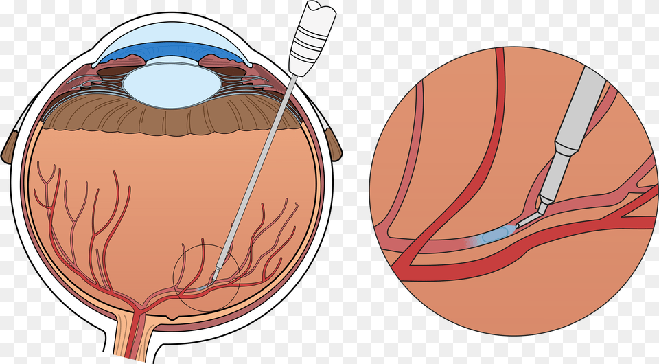 At The Moment Treatment Consists Of Monthly Injections Robot Assist For Retinal Vein Cannulation, Racket, Face, Head, Person Png Image