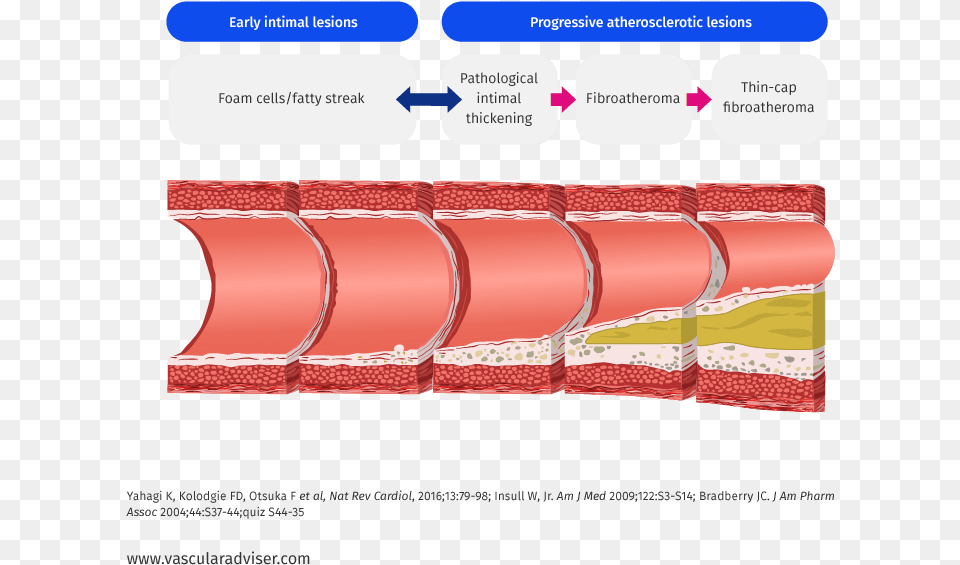 Atherosclerotic Lesion Development Lesion, Dynamite, Weapon, Text Free Png Download