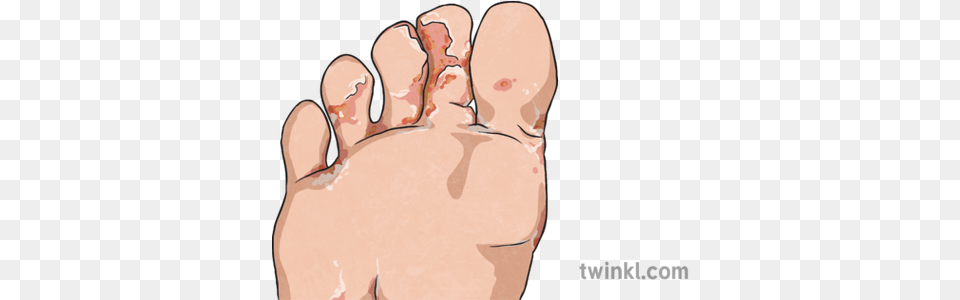 Athletes Foot Illustration Foot, Body Part, Person, Toe Png