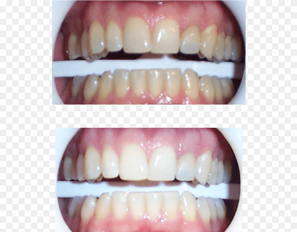 Austin Teeth Whitening Zoom Whitening Before And After, Body Part, Mouth, Person, Head Png Image