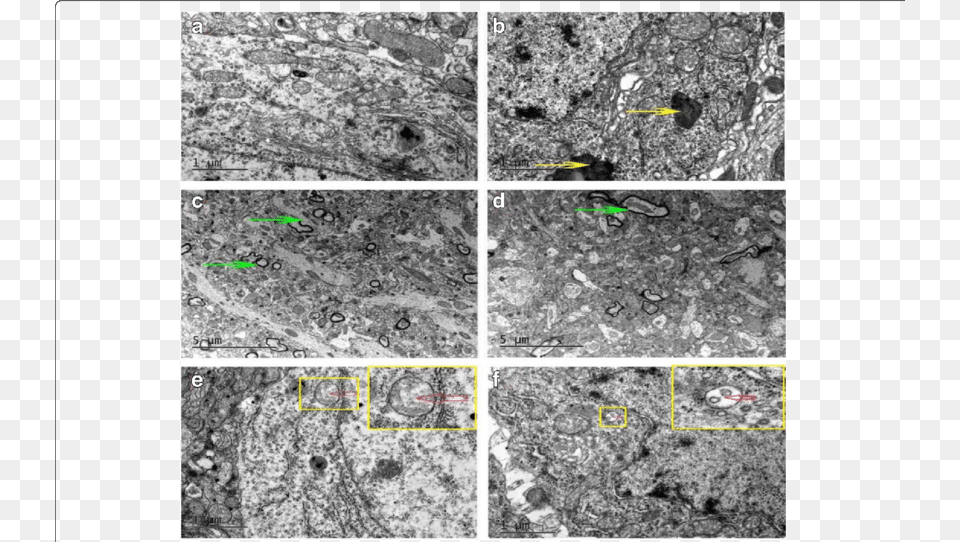 Autophagosomes Existed In Both Control And Diabetic Hippocampus Ultrastructure, Art, Collage, Rock Png Image