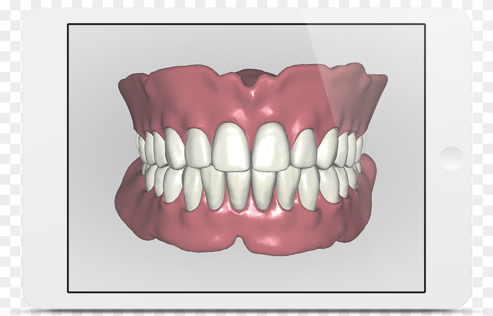 Avadent Ipad 3d Gebitsprothese, Body Part, Mouth, Person, Teeth Png Image