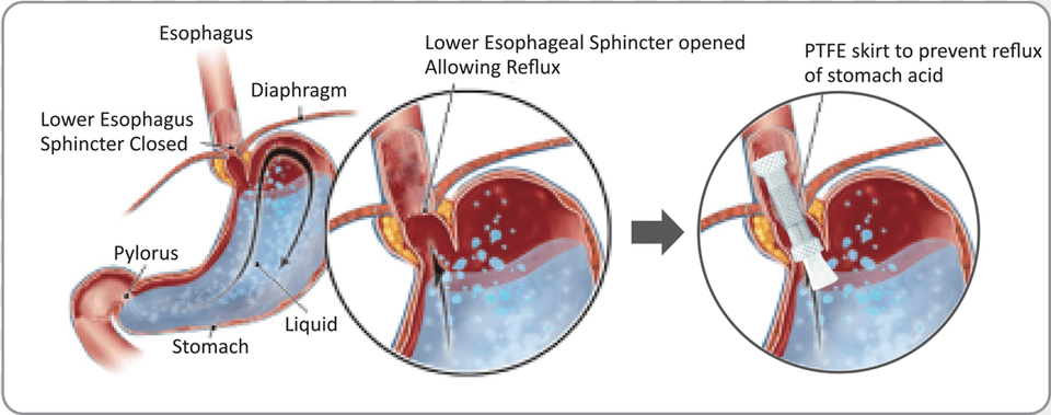 B Anti Reflux Esophageal Stent, Smoke Pipe Free Transparent Png