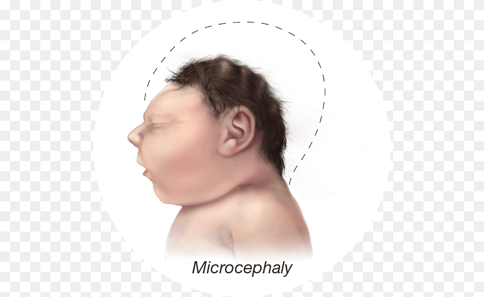 Baby Small Head Zika Baby, Body Part, Face, Neck, Person Free Transparent Png